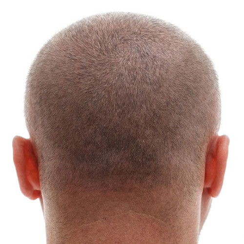 After image of Hair Loss at Sultan Al Olama Dermatology clinic dubai