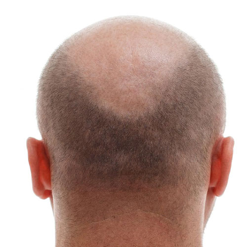 Before image of Hair Loss at Sultan Al Olama dermatology clinic dubai
