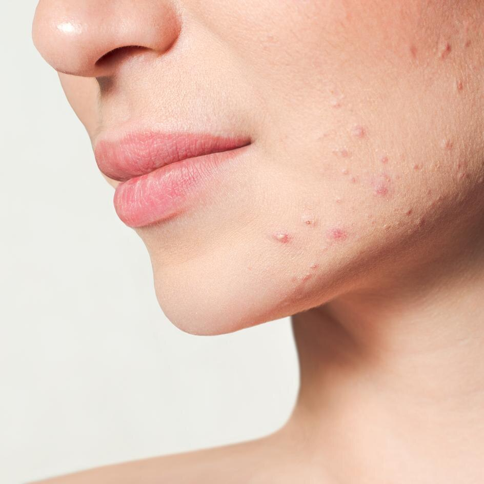 Image of Acne breakout before image at Sultan Al Olama Dermatology clinic dubai