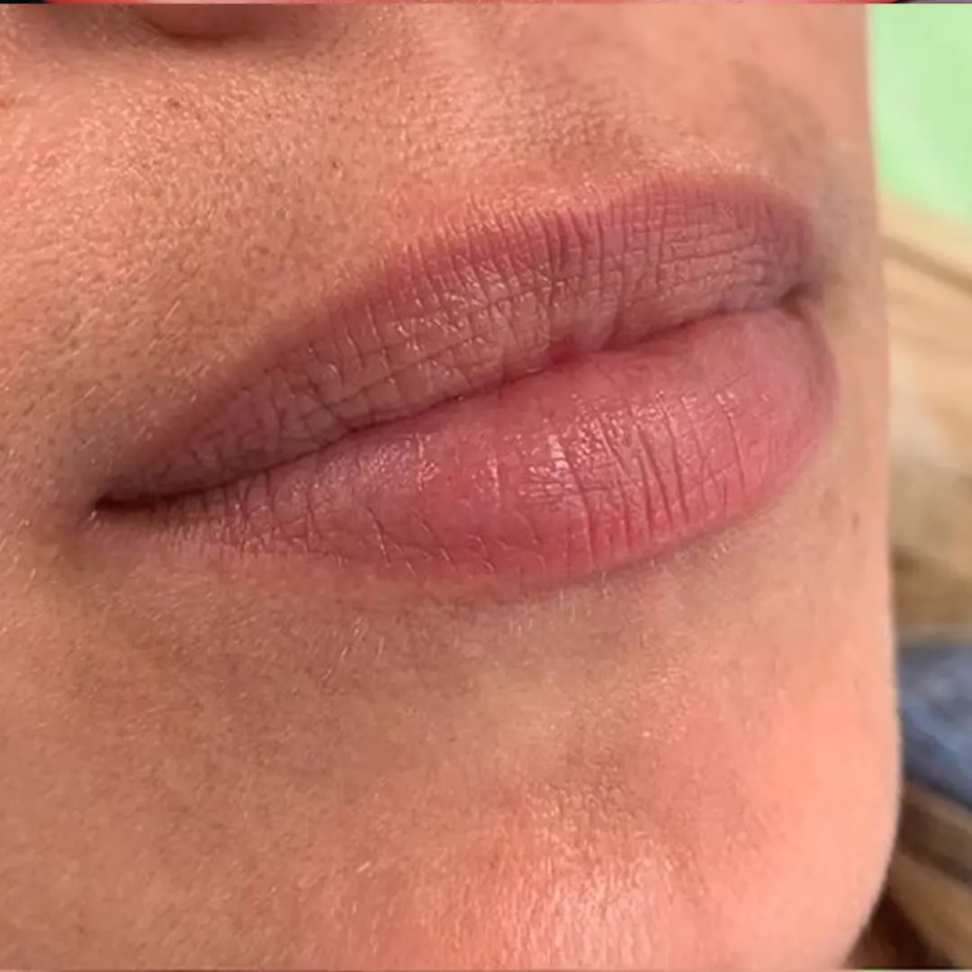 Lip Filler Before (2)