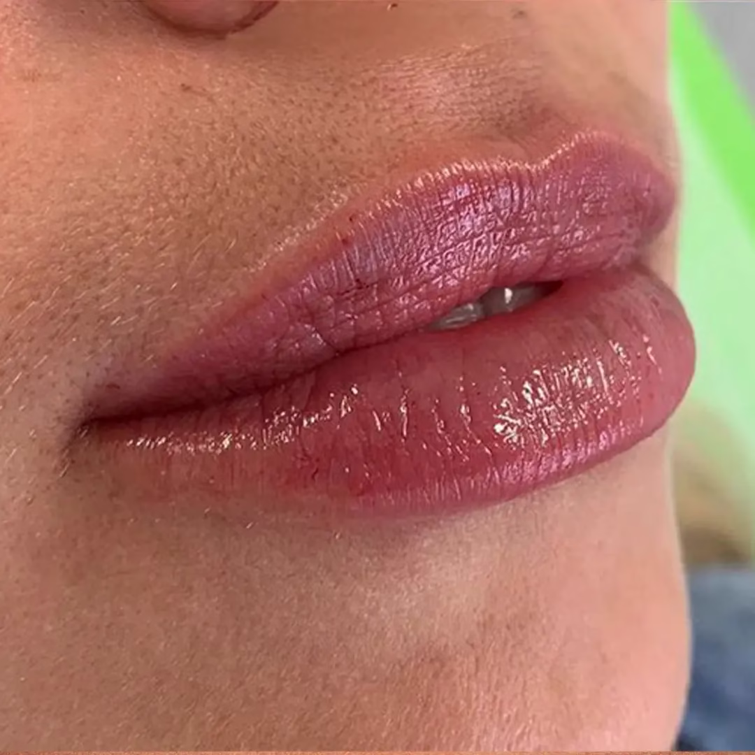 Lip Filler After (2)