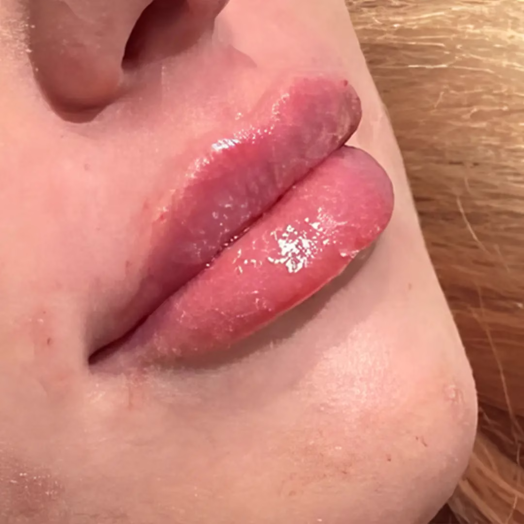 Lip Filler After (4) Lip Filler After (4)
