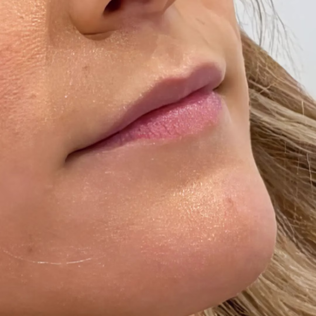 Lip Filler Before (3) Lip Filler Before (3)