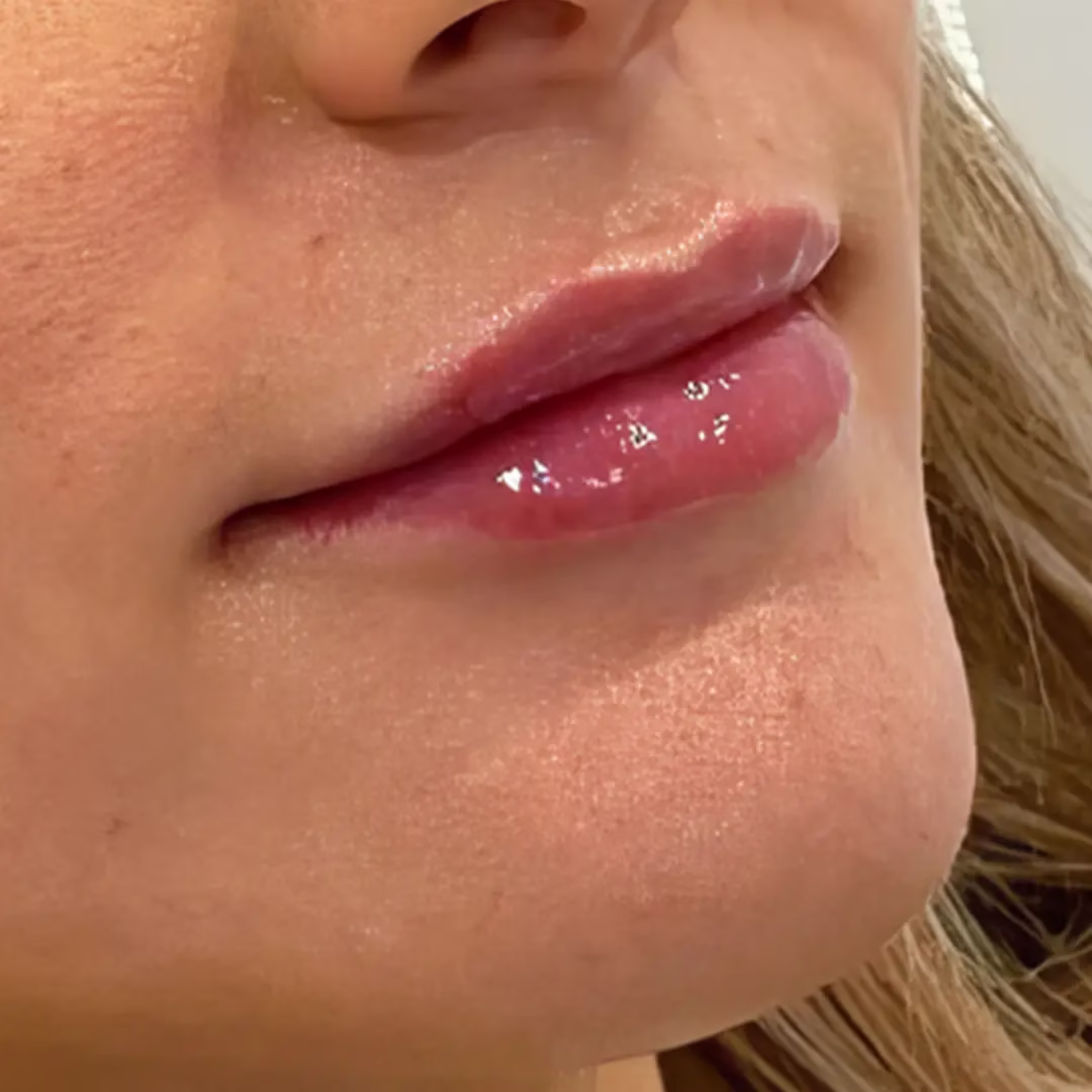 Lip Filler After (3) Lip Filler After (3)