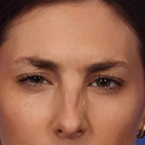 11 Lines Botox (After) 11 Lines Botox (After)