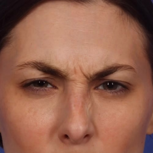 11 Lines Botox (Before) 11 Lines Botox (Before)