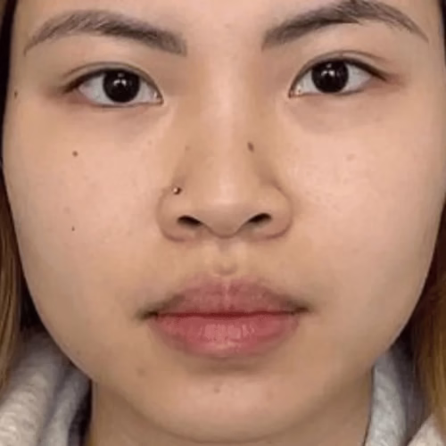 Masseter Botox (After-1) Masseter Botox (After-1)