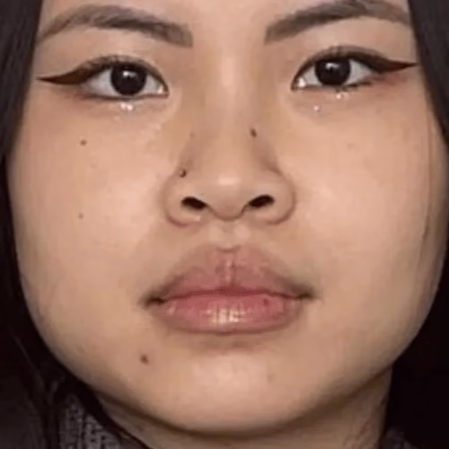 Masseter Botox (Before) Masseter Botox (Before)