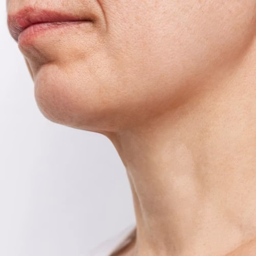 Neck Botox (After) Neck Botox (After)