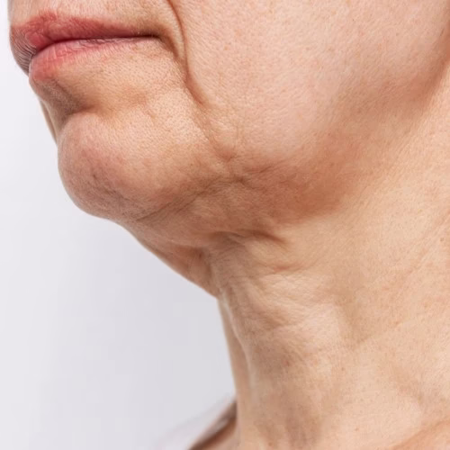 Neck Botox (Before) Neck Botox (Before)